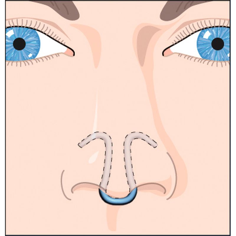Dilatateur nasal Clip Air